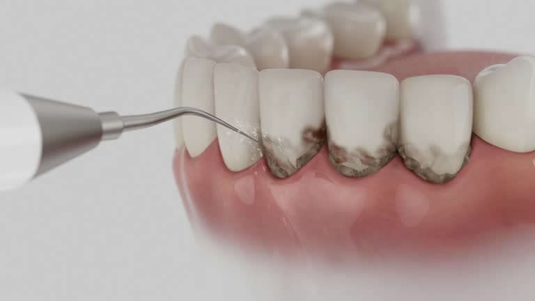 Trusted Teeth Cleaning And Checkup service in Westerville, OH - Dentist Open Now